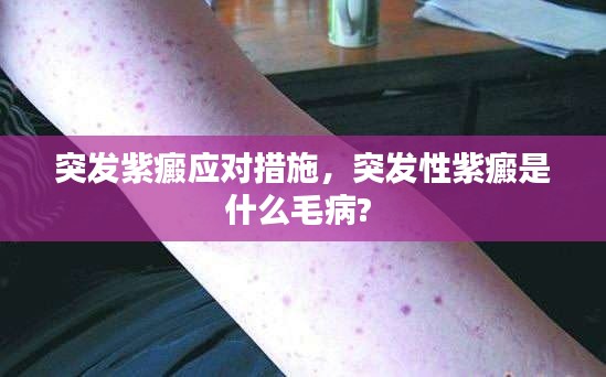 突发紫癜应对措施,突发性紫癜是什么毛病?